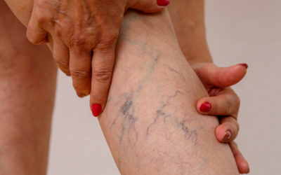 Homeopathy Treatment for Varicose Veins