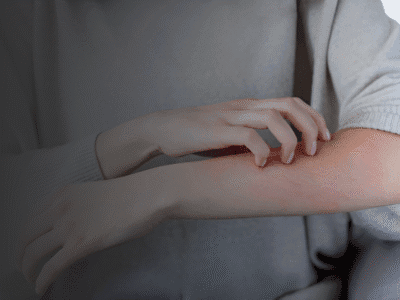 Homeopathy for Skin Problems