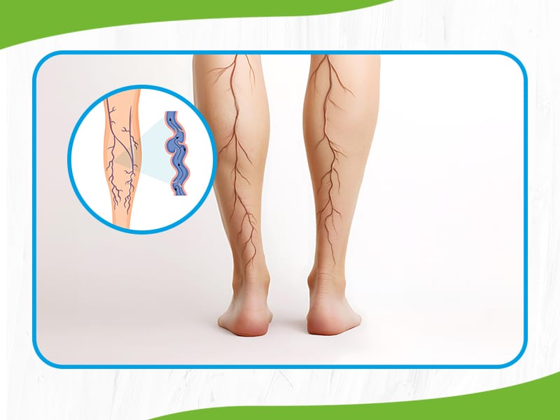 Vascular Disorder