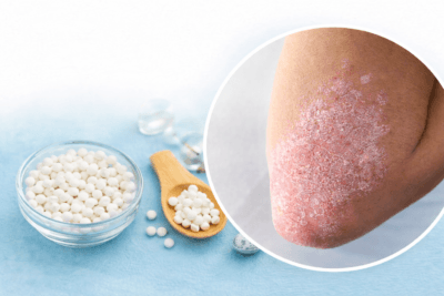 Homeopathy Treatment for Psoriasis Thumb